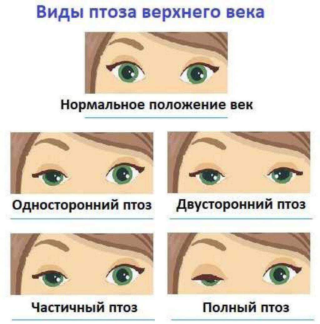 Частичный птоз верхнего века. как лечить?