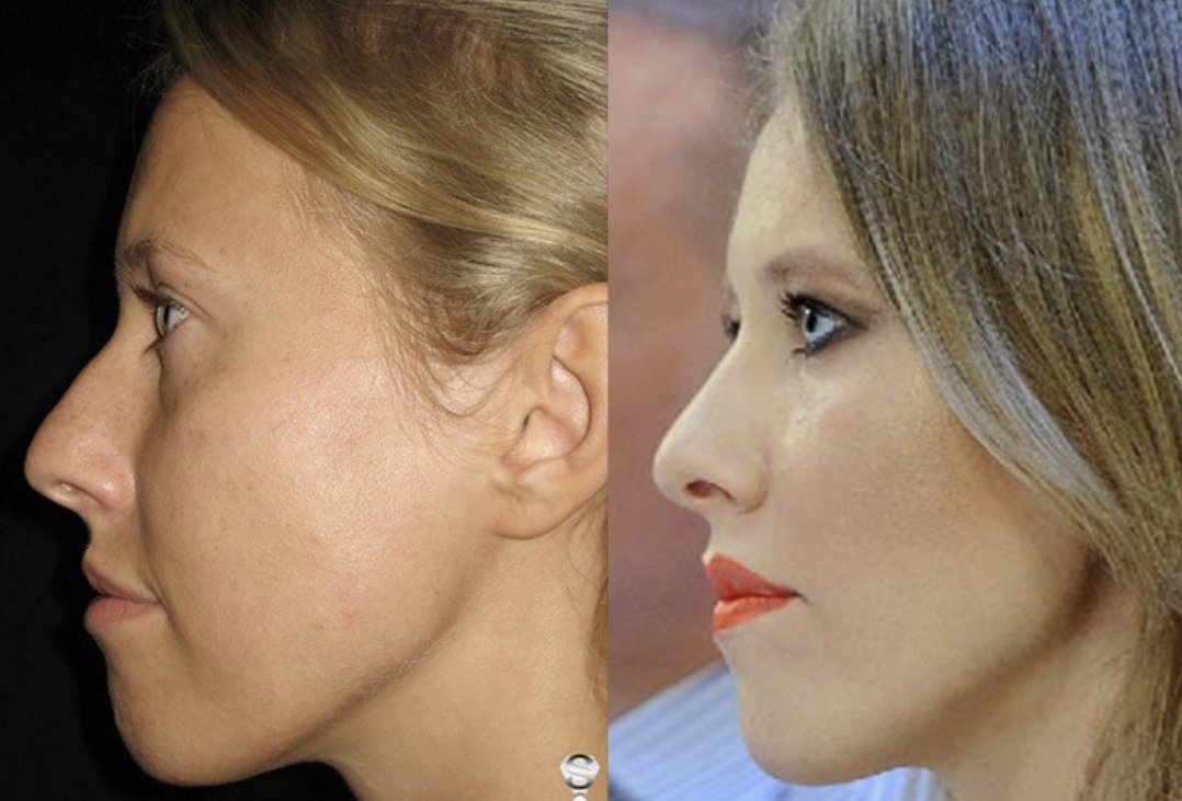 Большой нос: причины возникновения, методы коррекции без операции и с помощью пластической хирургии
