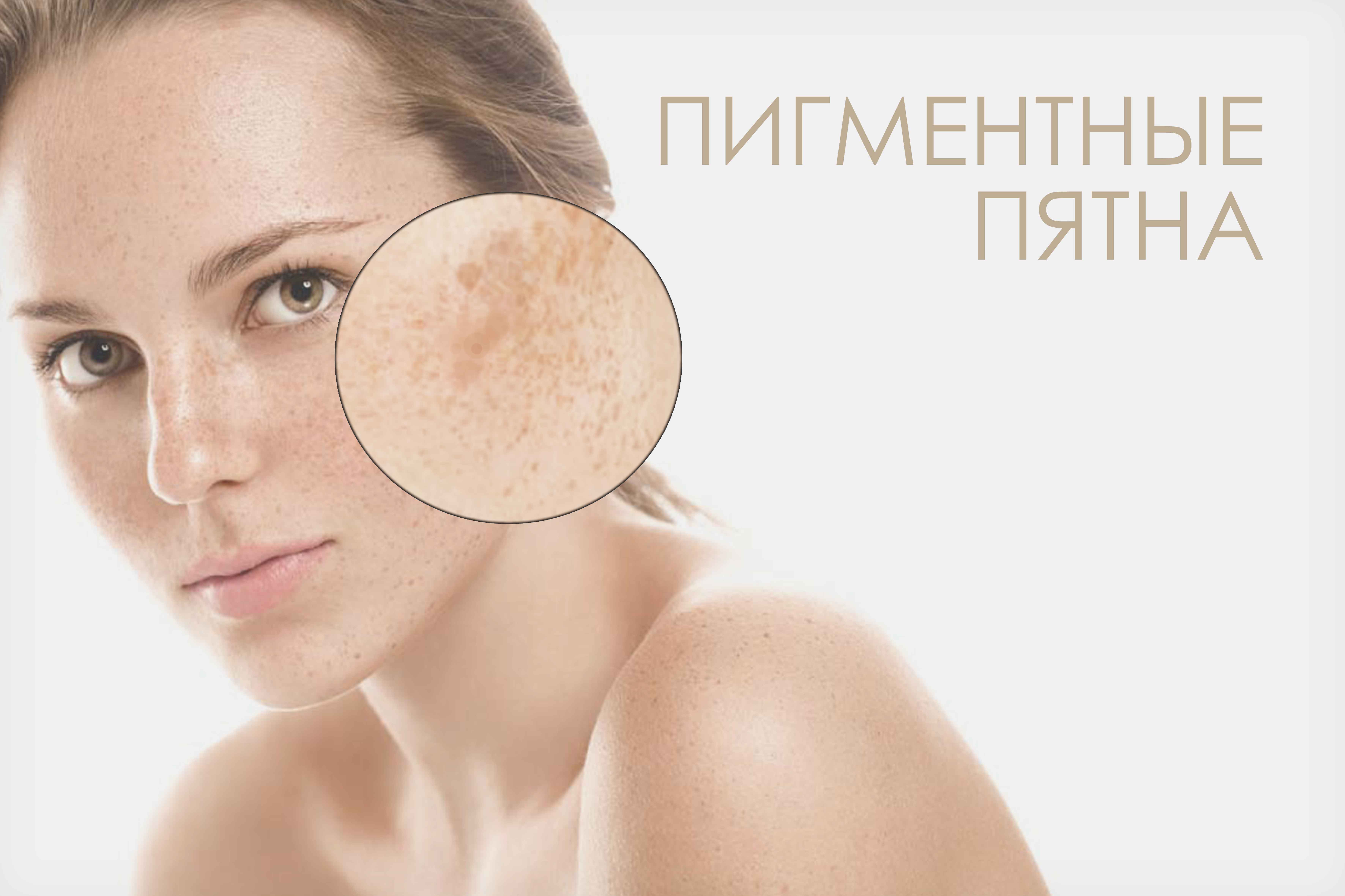 Как избавиться от пигментных пятен: способы удаления пигментации на лице и теле в домашних условиях и салоне косметологии