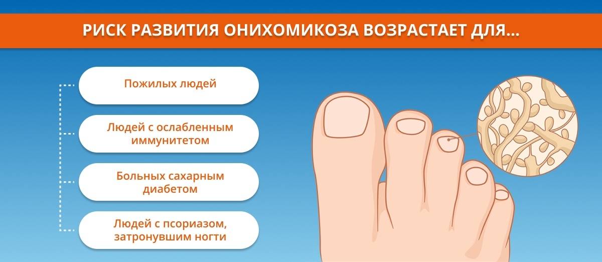 Микоз ногтей (онихомикоз) - симптомы болезни, профилактика и лечение микоза ногтей (онихомикоза), причины заболевания и его диагностика на eurolab