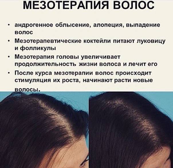 Плазмолифтинг волосистой части головы - плазмолифтинг для волос: до и после