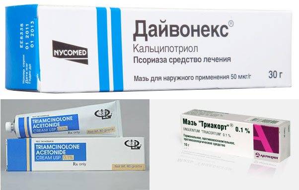 Что такое псориаз: виды, симптомы, лечение