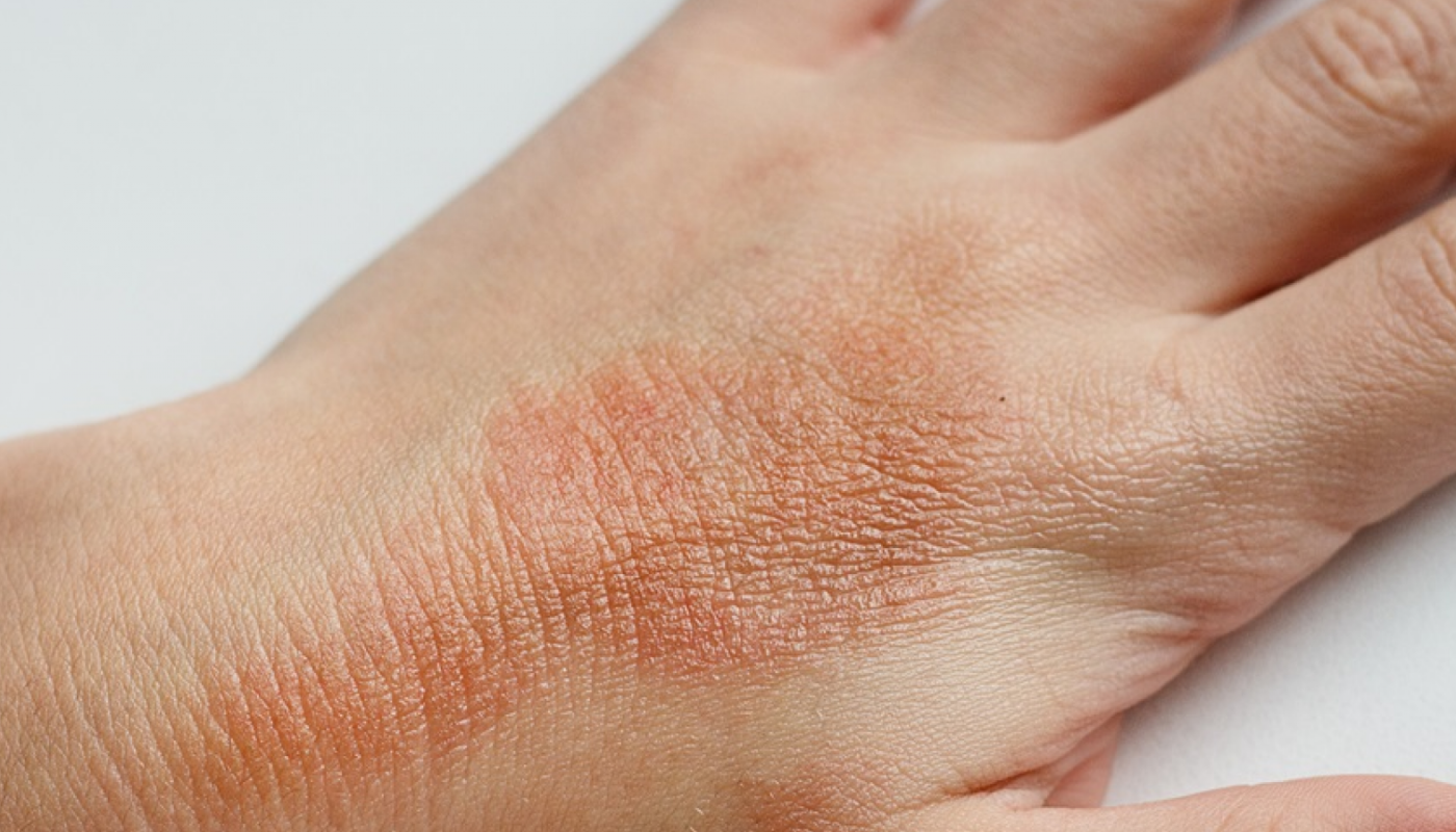 Шелушение кожи на теле: 7 причин и обзор 11 средств с отзывами