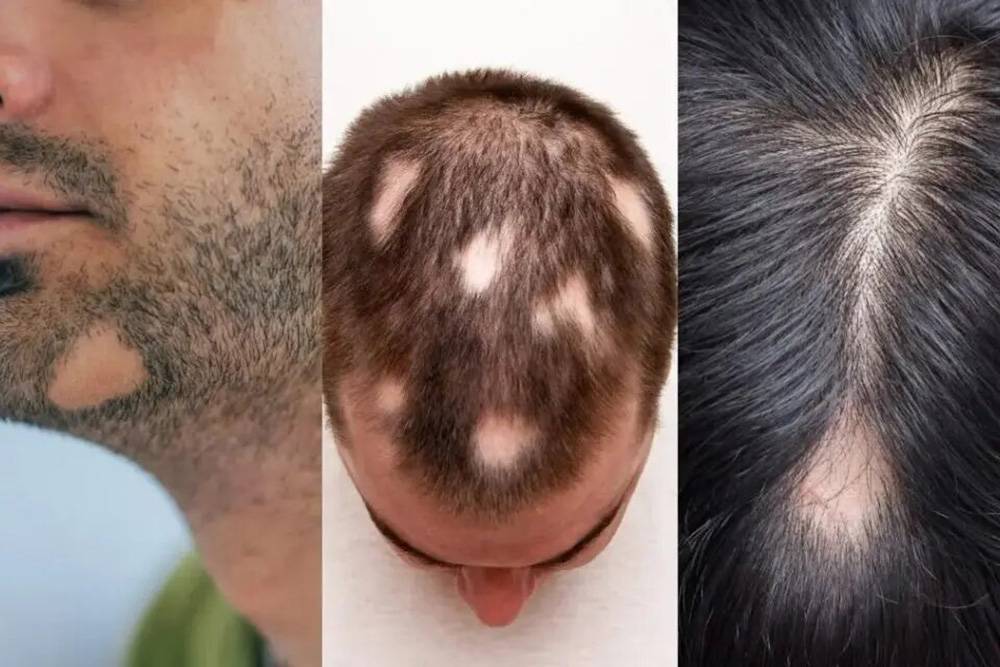 Алопеция — лечение, профилактика выпадения волос