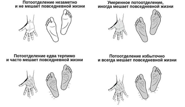 Гипергидроз стоп