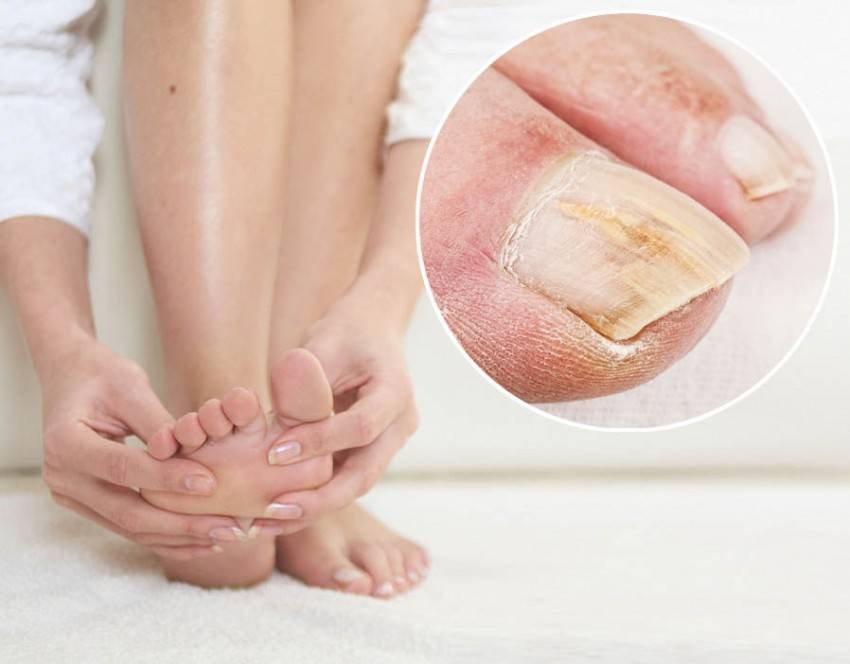 Грибок на ногах: чем лечить грибок стопы, средство от микоза стоп - напоправку – напоправку