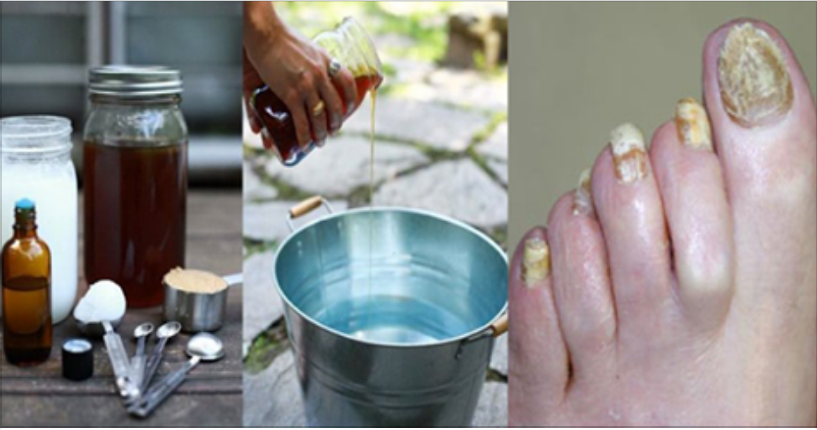 Эффективное лечение грибка ногтей рук. Народные средства от грибка ногтей. Вылечил ногти от грибка.