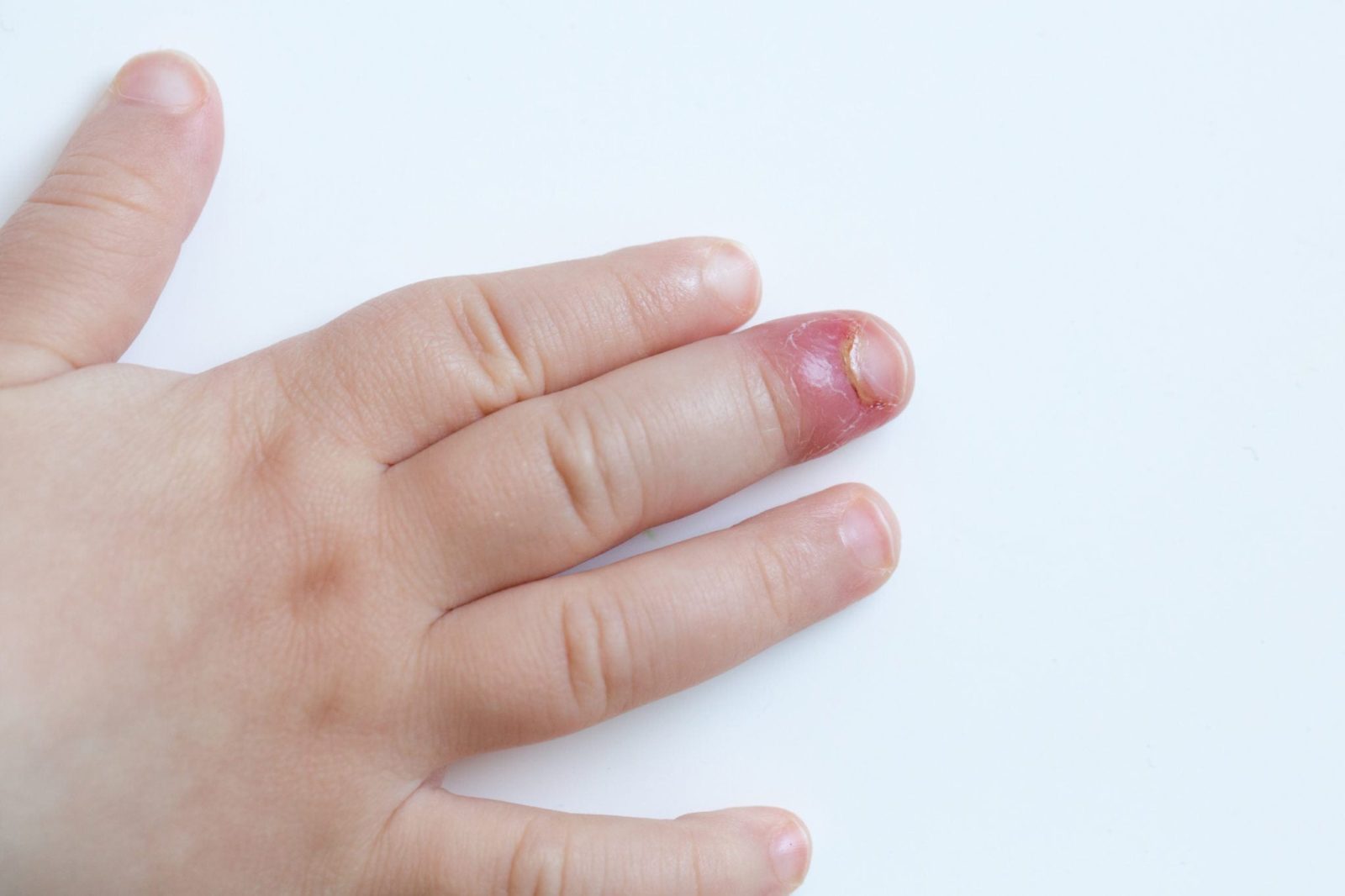 Средства для лечения грибка ногтей — самые эффективные лекарства