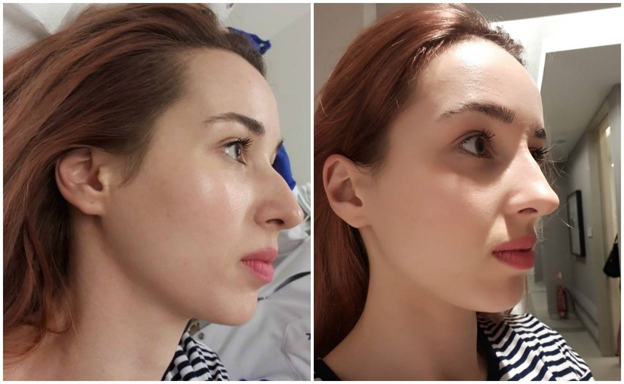 Дефекты носа, которые исправит ринопластика | журнал «код молодости» ????‍⚕️