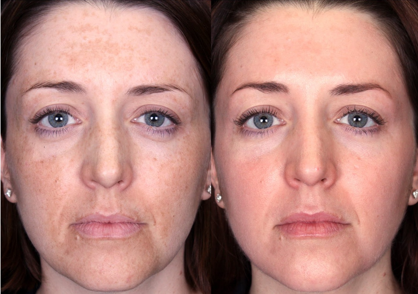 Пилинг лица: что это такое, плюсы и минусы процедуры (фото до и после)