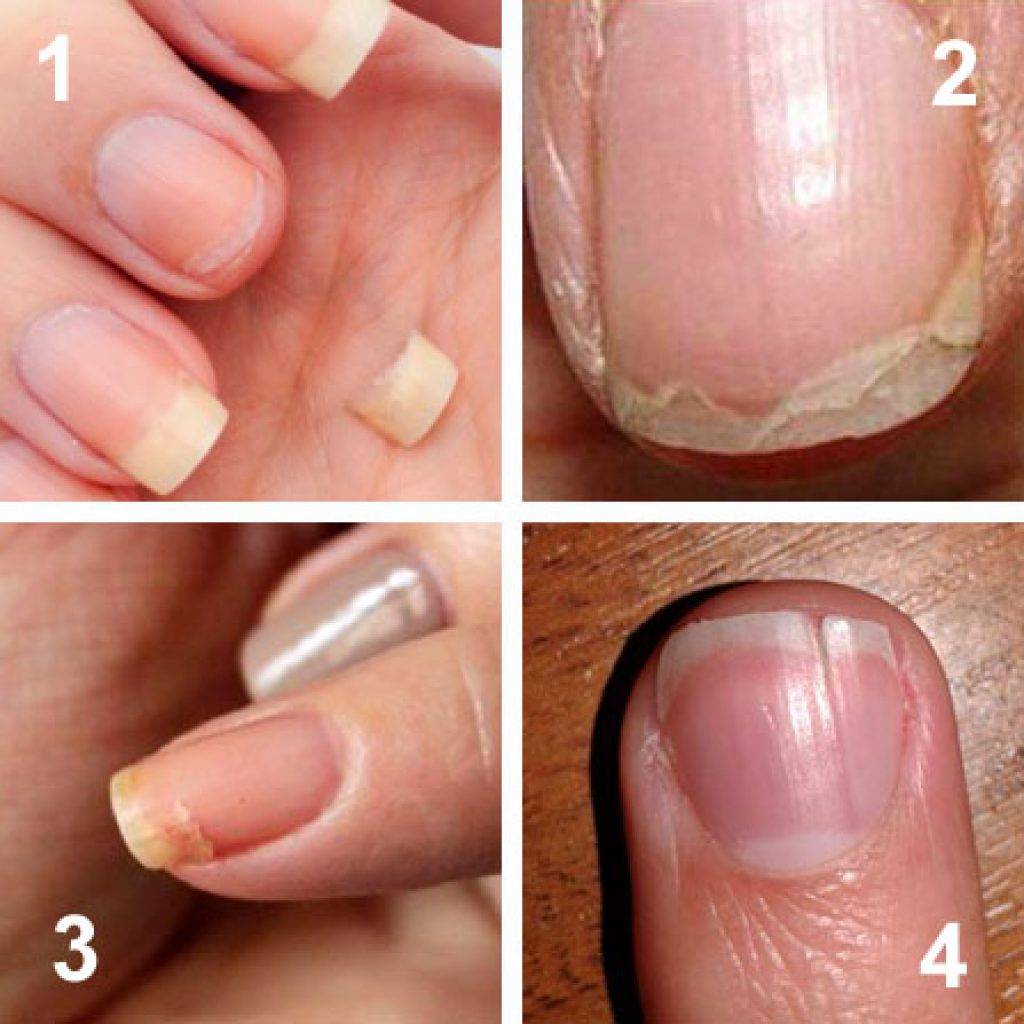 Как быстро восстановить ногти после наращивания