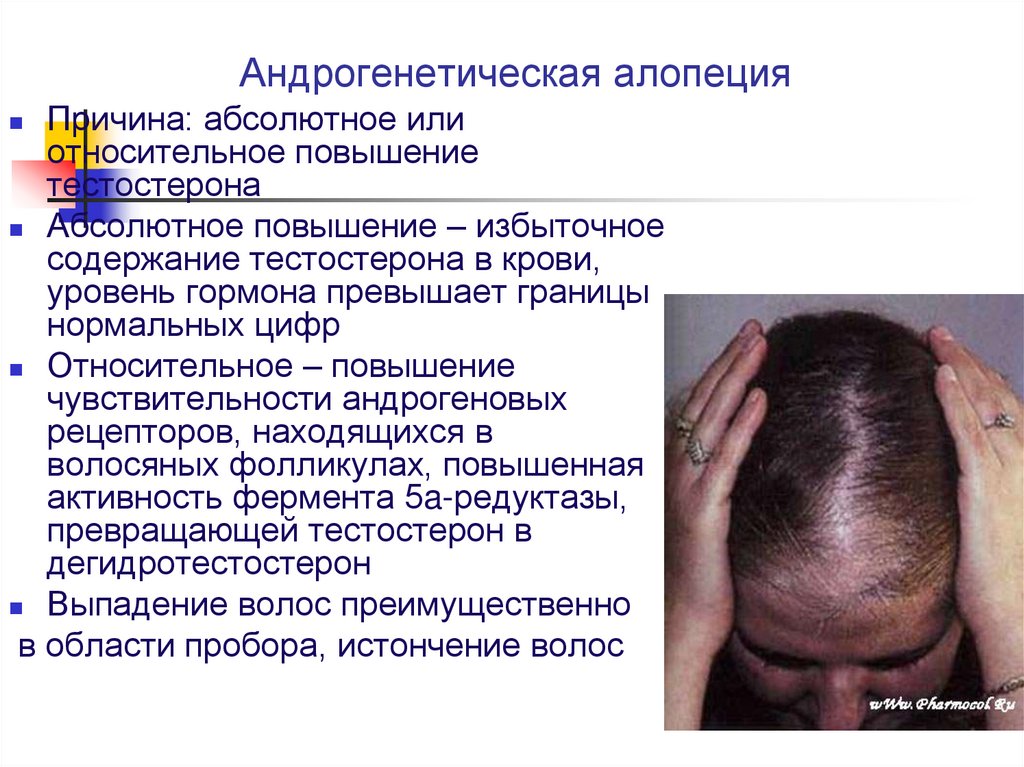 Андрогенная алопеция или выпадение волос по «мужскому типу» — причины и лечение