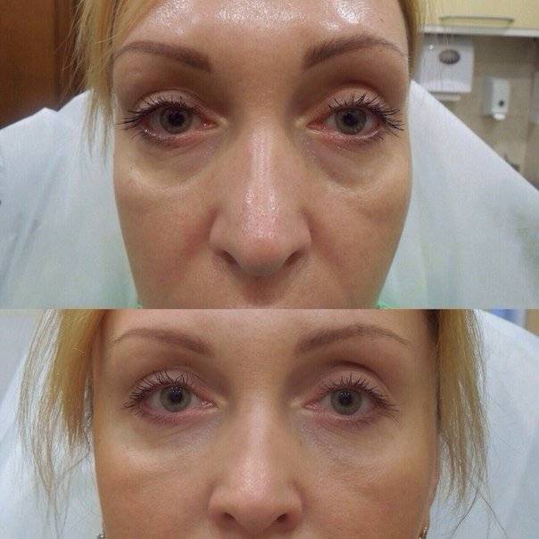Носослезная борозда коррекция до и после фото