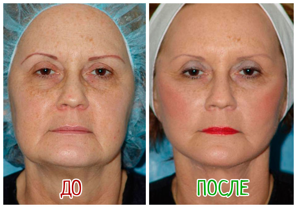 Круговая подтяжка лица: что это такое, фото до и после, реабилитация и восстановление