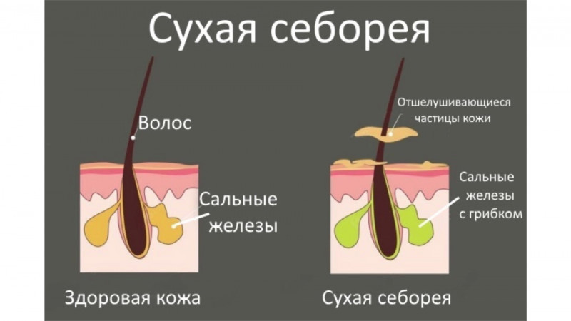 Как отличить сухой. Себорея волосяного Покрова. Сухая себорея кожи головы.