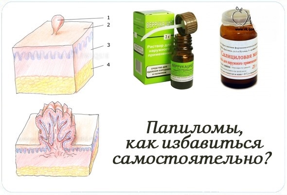 Чем удалить папилломы на лице без следа, лечение папиллом на лице народными средствами