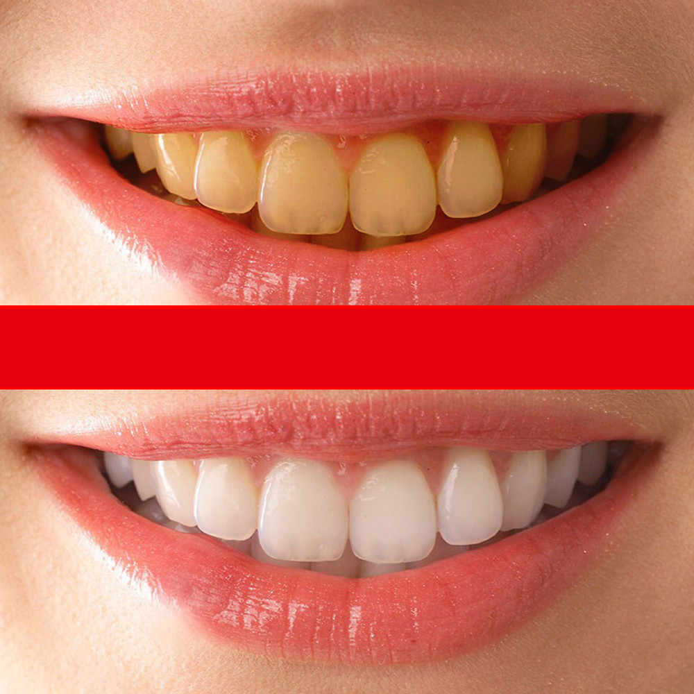 Лучший способ чистки зубов от камня - блог денталюкс