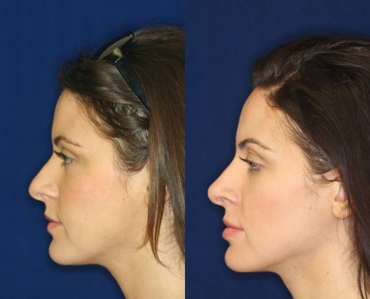 Ринопластика курносого носа: фото до и после, показания и противопоказания