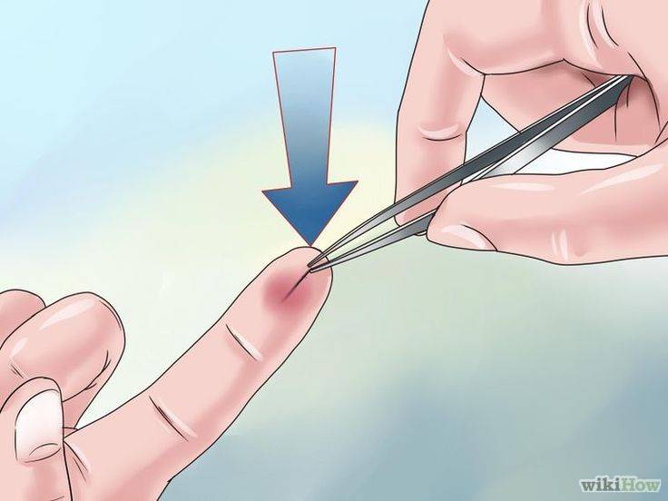 Как вытащить занозу из волоса