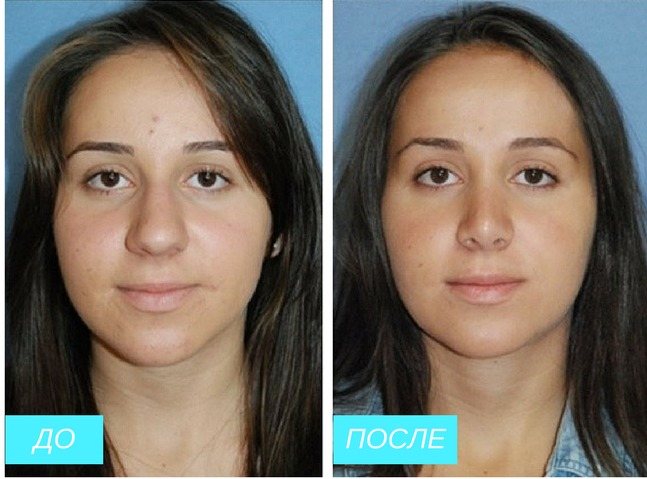 Ринопластика кончика носа - фото до и после, видео и отзывы о пластике кончика носа