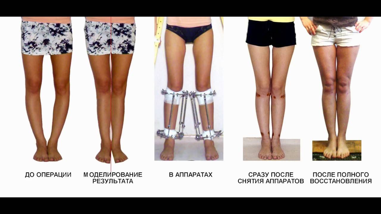 Как скрывать кривые ноги при помощи одежды: простые, но действенные лайфхаки