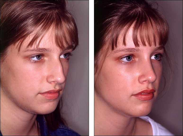 Нос после ринопластики фото до и после