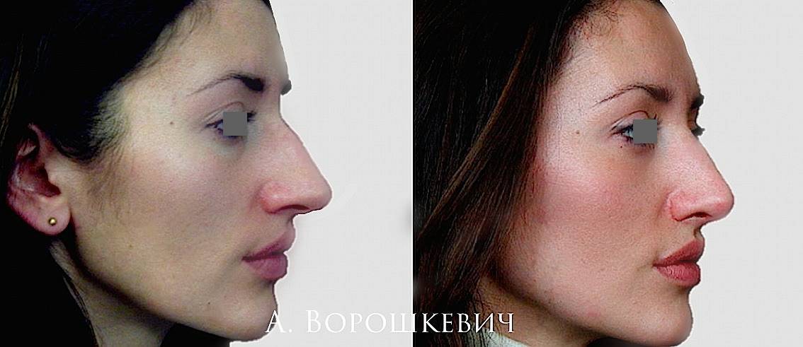 Пластика горбинки носа - стоимость, фото до и после