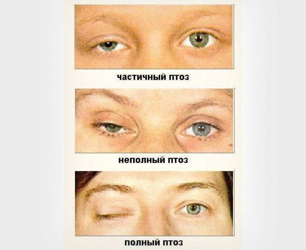 Птоз верхнего века: причины, лечение – когда нужна операция при птозе века?