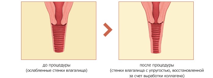 Как сузить влагалище, мышцы, стенки сделать узким после родов