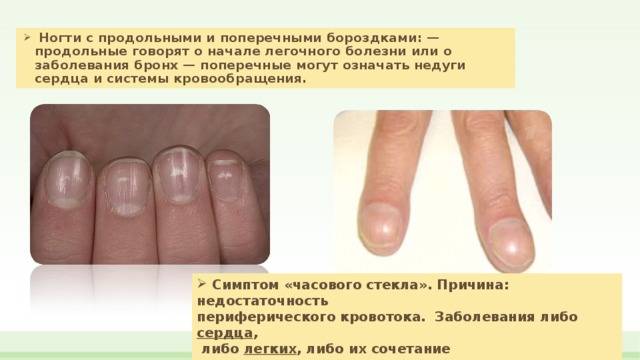 Черные полоски на ногтях: причины появления продольных полос и как их лечить