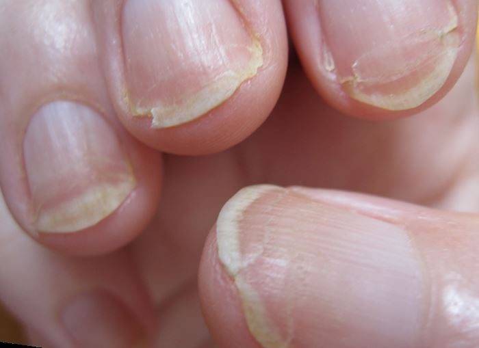 Травма ногтя – необходимые действия
