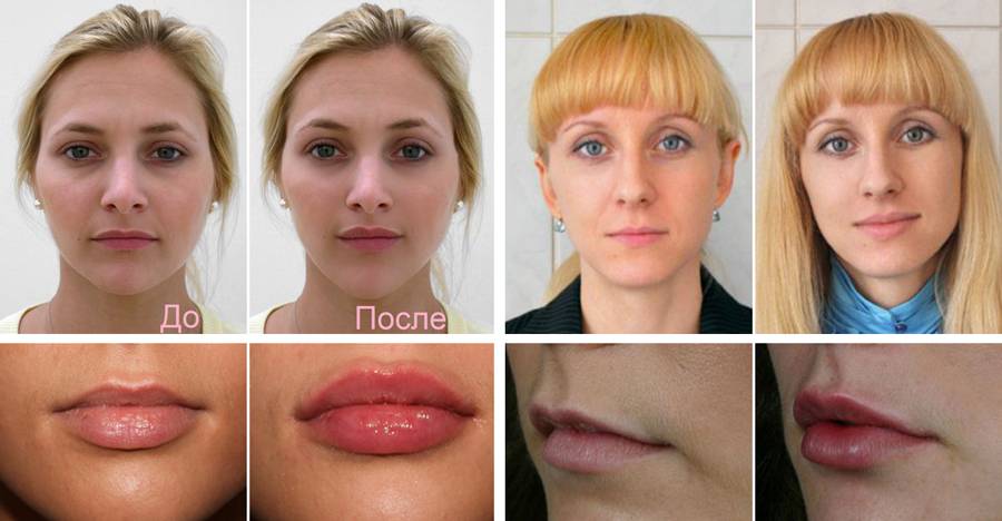 Контурная пластика губ гиалуроновой кислотой: фото до и после