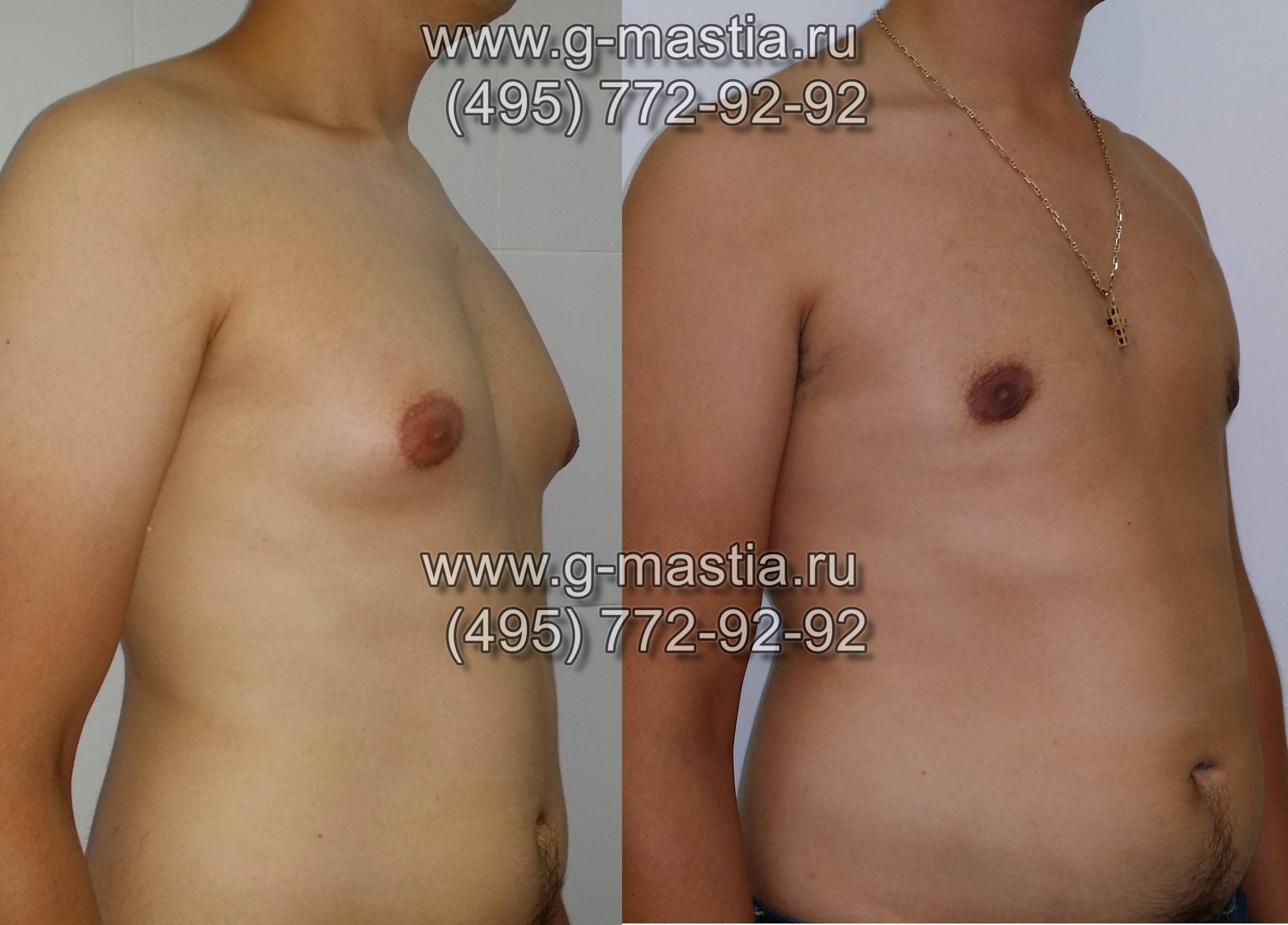 изменения ареолы груди при беременности фото 86