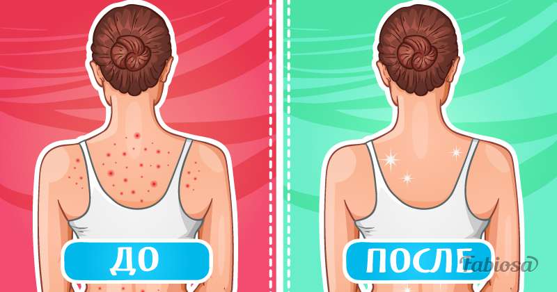 Бактериальные инфекции кожи: какие бывают, как лечить