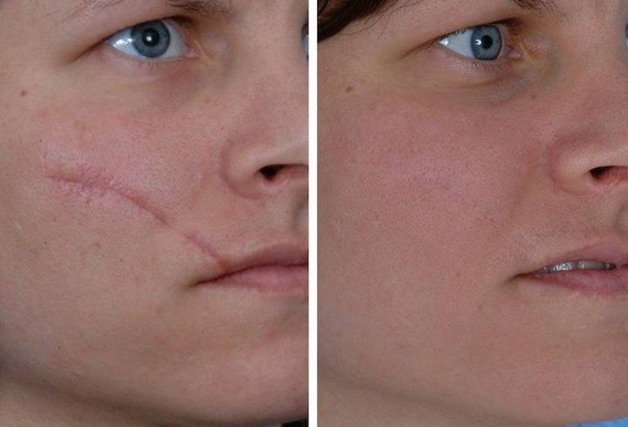 Хирургическое иссечение рубцов на лице и теле, особенности операции по иссечению рубца
