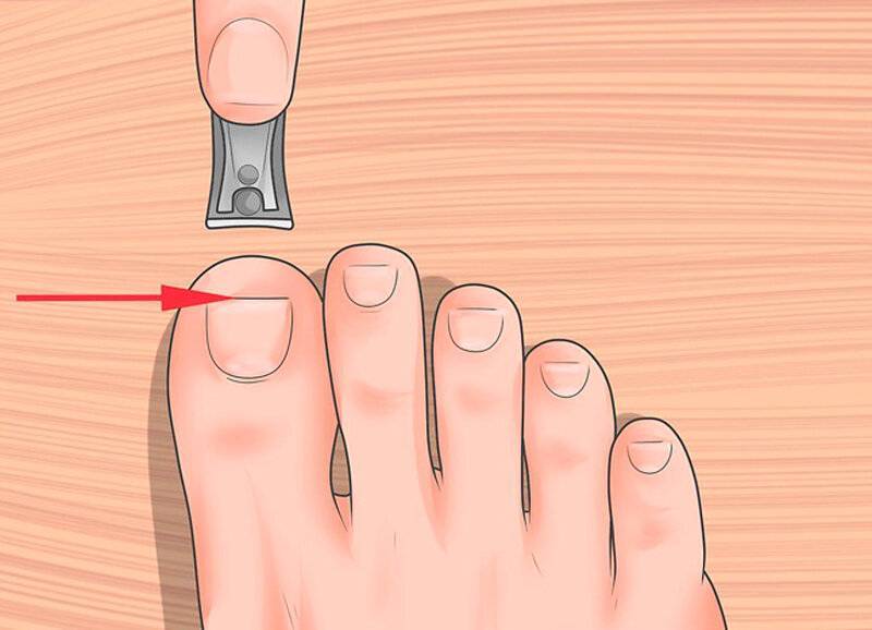 Как правильно подстричь вросший ноготь на ноге: куда обратиться и что делать