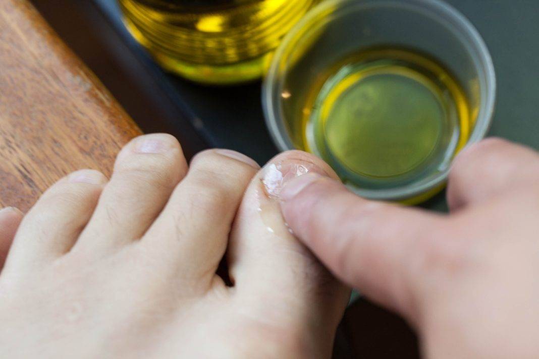 Выбираем эфирное масло для лечения грибка ногтей (топ-5 средств)
