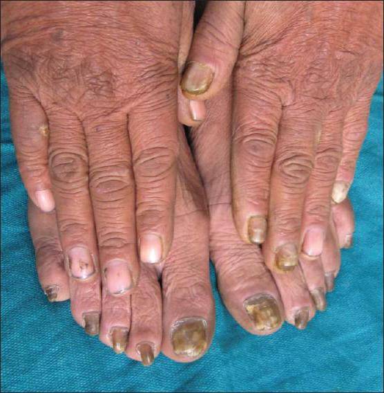 Основные причины, почему синеют ногти на руках и ногах