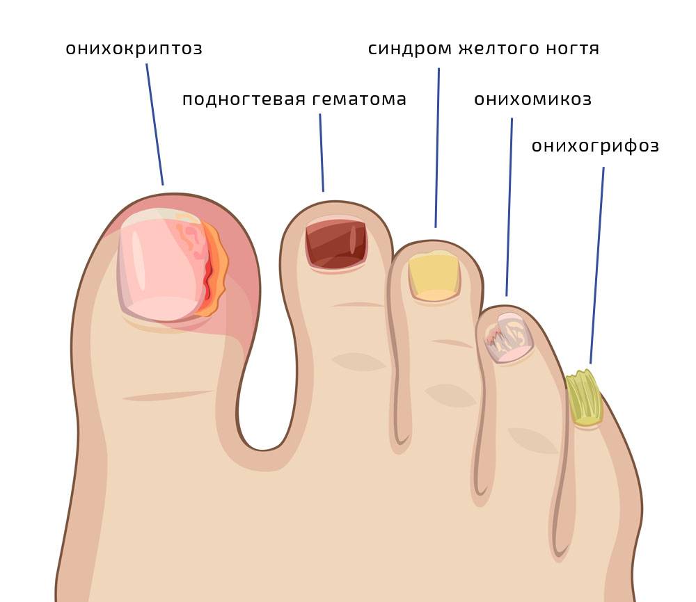 Грибок ногтей на ногах — виды грибков, описание появления и варианты лечения. 110 фото грибков на ногах
