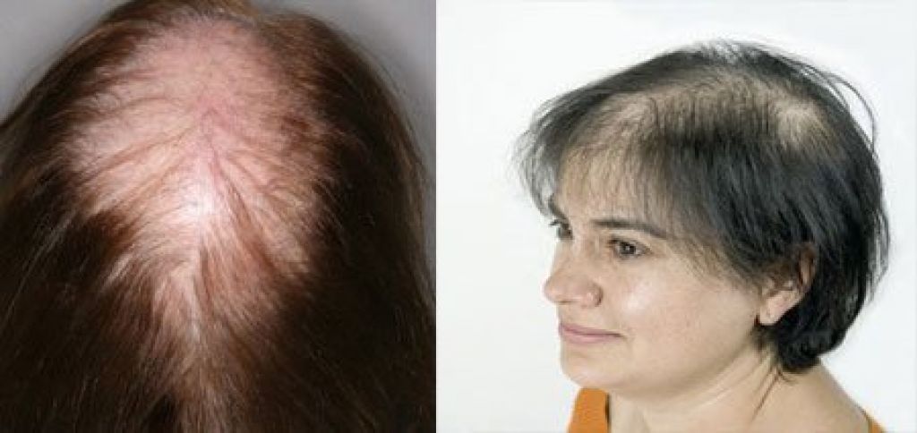 Андрогенное выпадение волос у женщин