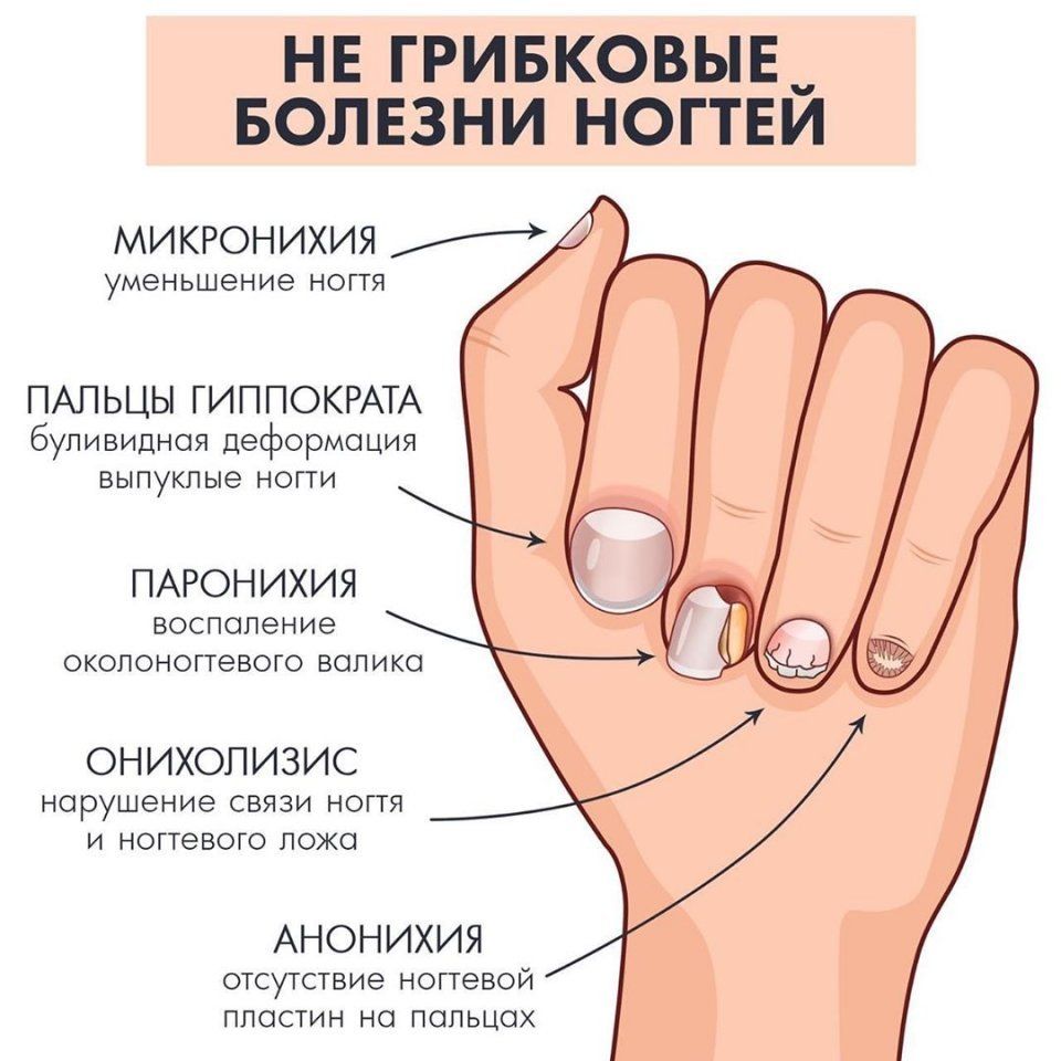 Ногти заболевание по ногтям