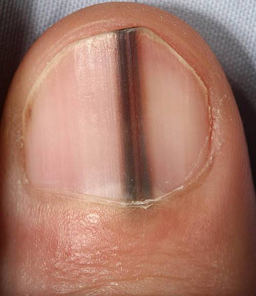 Полосы на ногтях что значит. Подноктевавая меланома.