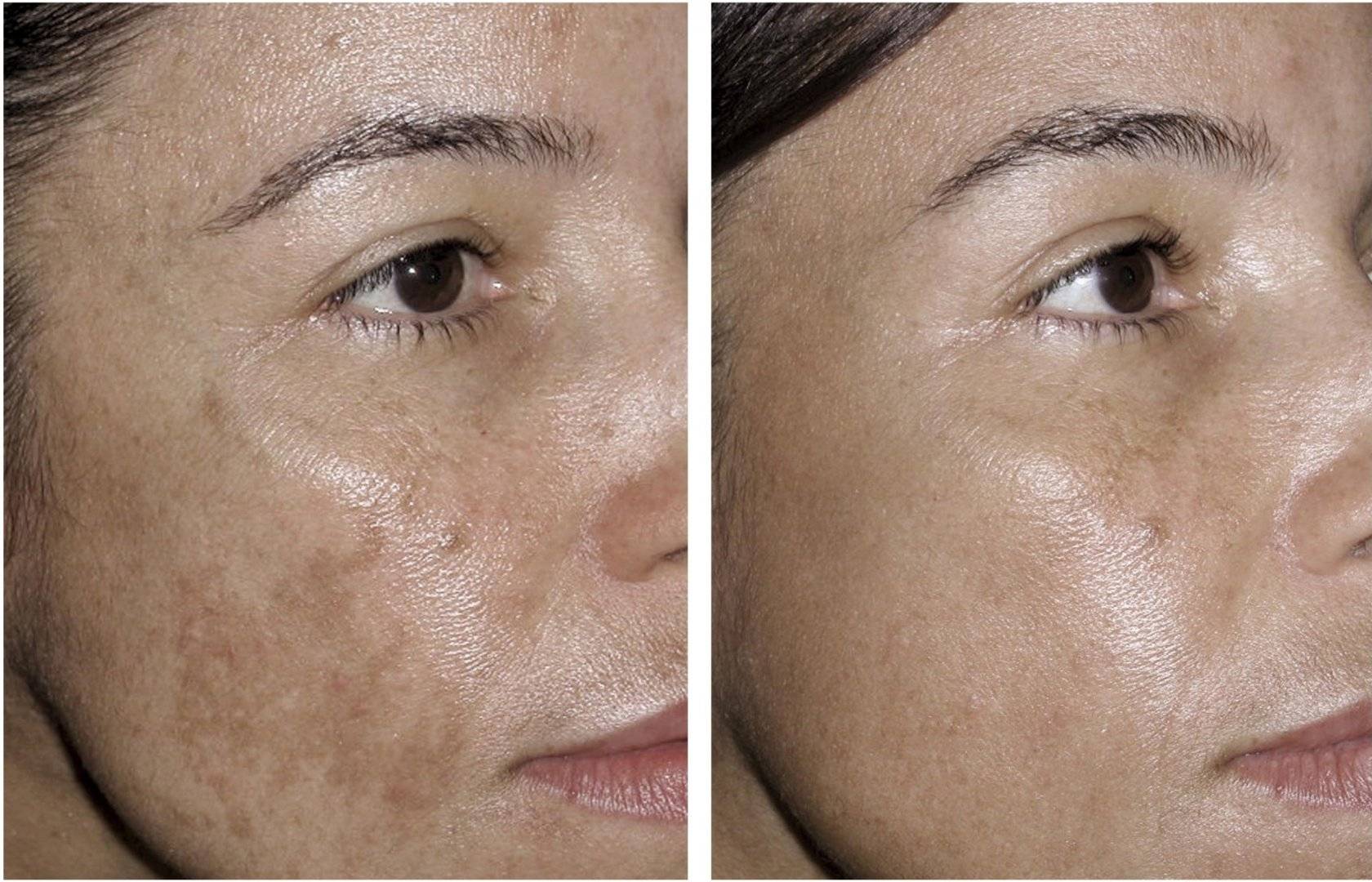 Лазерное отбеливание лица до и после кожи фото