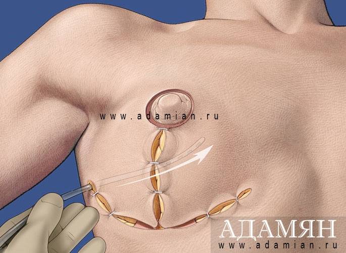 Уменьшение ареол груди | статьи и советы | блог клиники пластической хирургии «основа»