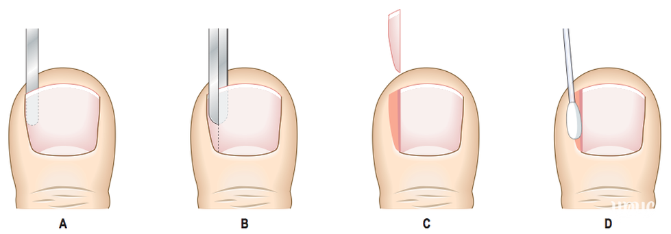 Удаление ногтевой пластинки — клиника "виромед"