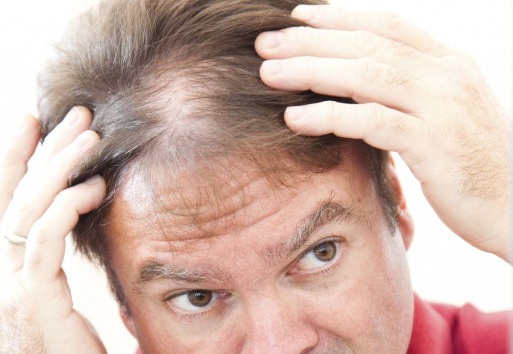 Причины выпадения волос у мужчин и как остановить выпадение волос