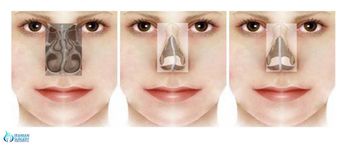 Ринопластика: виды и методы коррекции носа