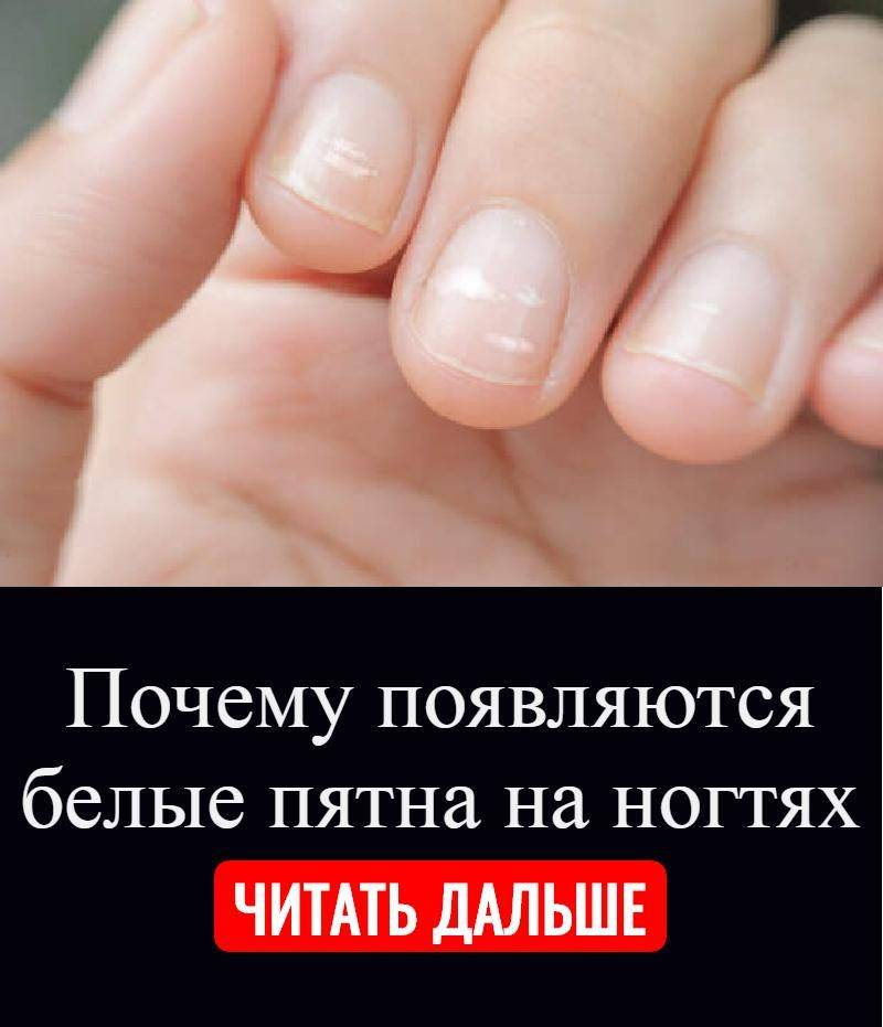Почему появляются белые пятна на ногтях пальцев рук - причины, как избавиться - medside.ru