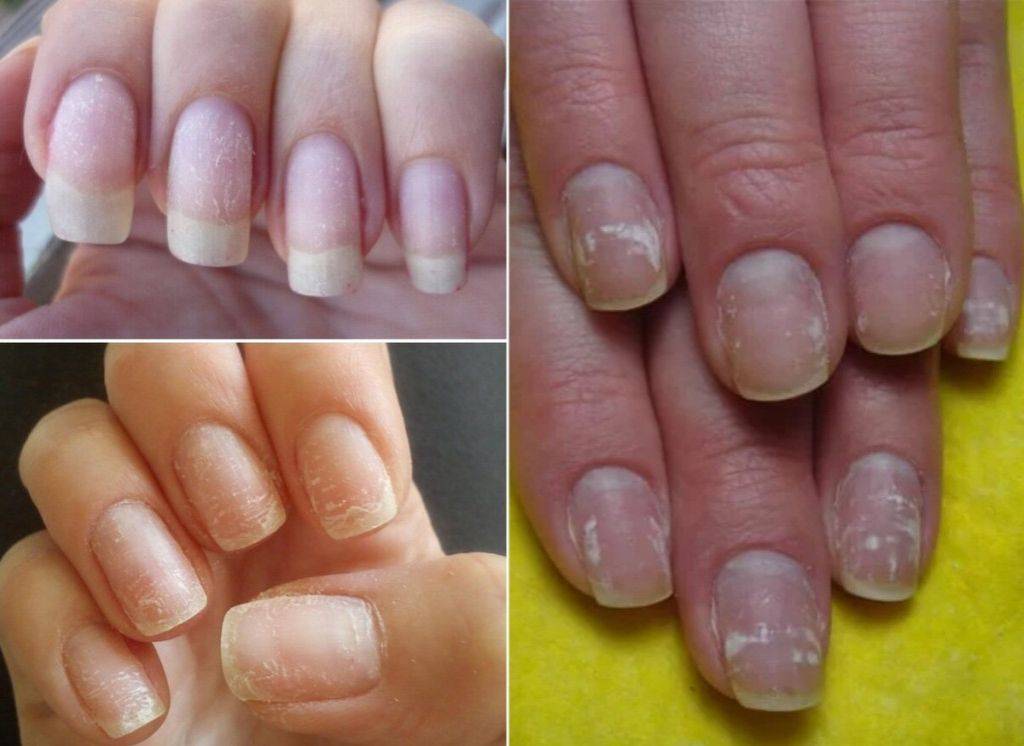 Как быстро восстановить ногти после наращивания в домашних условиях