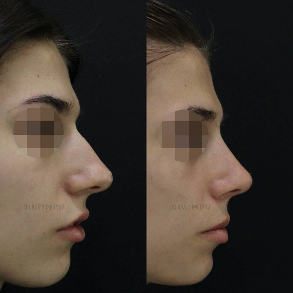 Коррекция носа филлерами | контурная пластика носа - безоперационная ринопластика филлерами в клинике алтеро